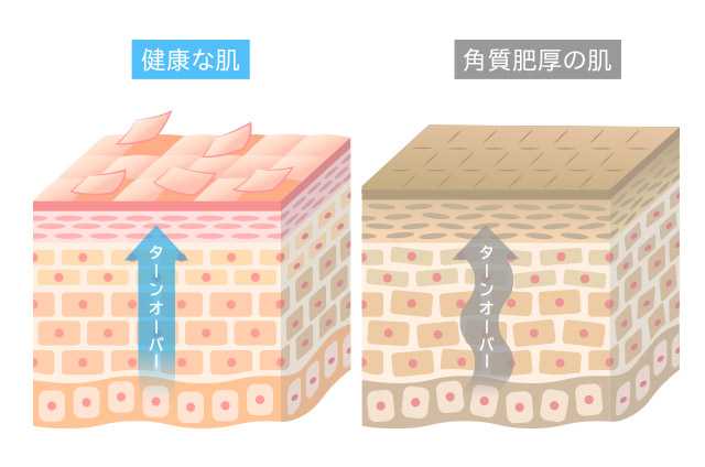 古い角質を除去しターンオーバーサイクルを整える